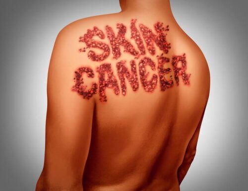 Skin cancer